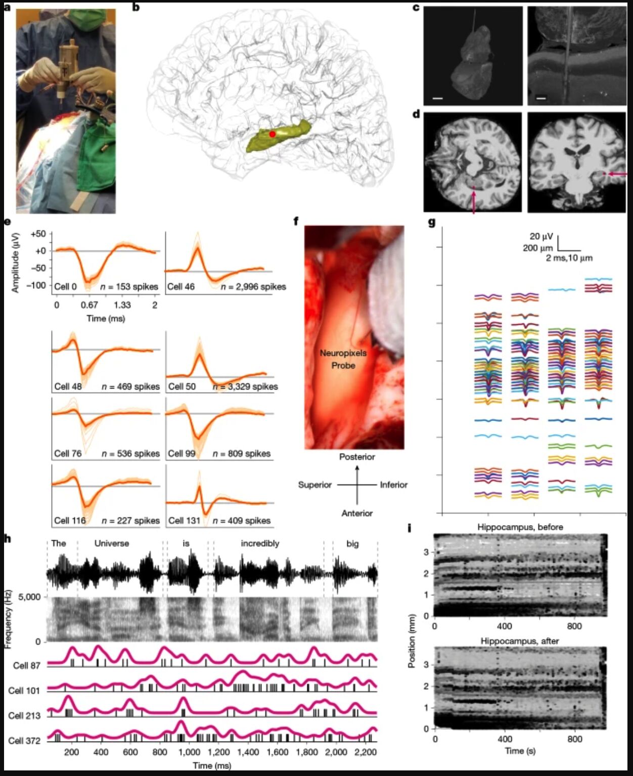Neuropixels recordings from the human hippocampus under general anaesthesia.